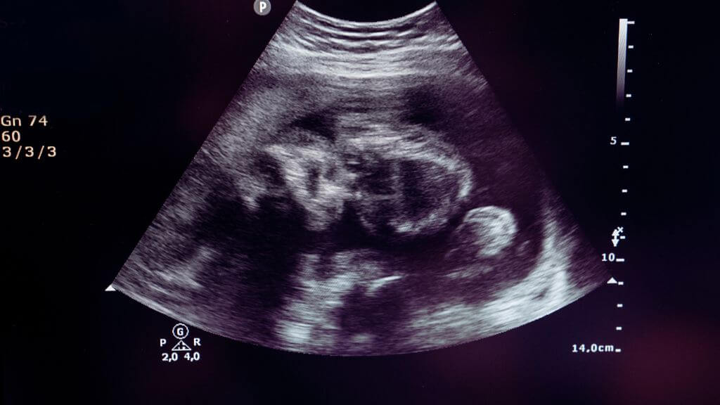 increasing abortion rate in NZ