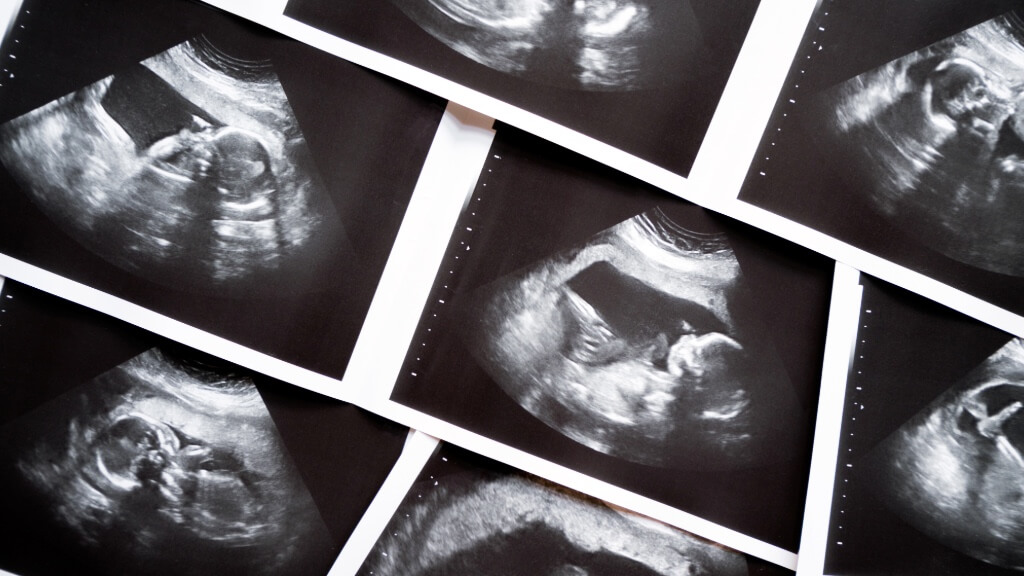 Abortion pill dominates as US records 1.13 Million abortions in 2025